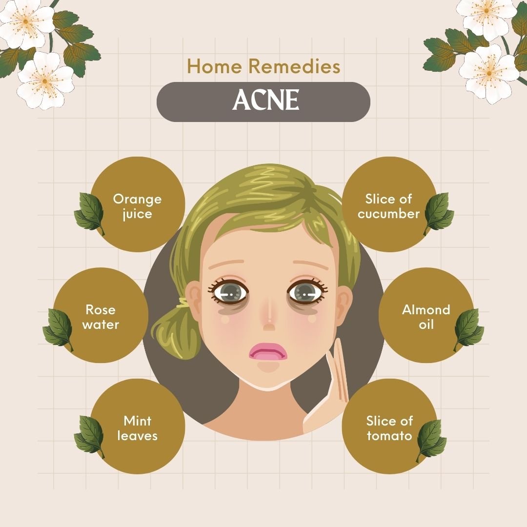 PCOS Acne Blog Image - Exploring Home Remedies for Dark Circles with insights from Dr. Shabnam Sharjil at PCOS Ferticure Clinic for holistic PCOS-PCOD management.